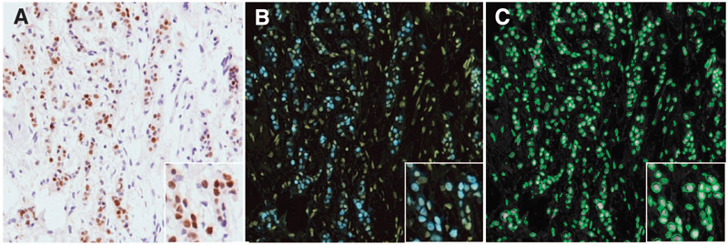 click on the image to enlarge CELLEXtractor: Image processing for quantification of breast tumour histopathology